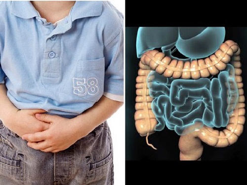 Hội chứng ruột kích thích cũng gây đau bụng ở trẻ