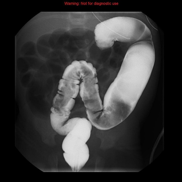 Hình ảnh chụp X-quang của bệnh nhân bị phình đại tràng
