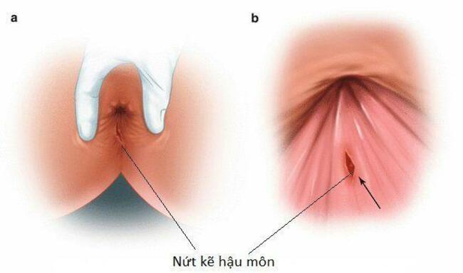Nứt kẽ hậu môn và chảy máu hậu môn ở trẻ nhỏ